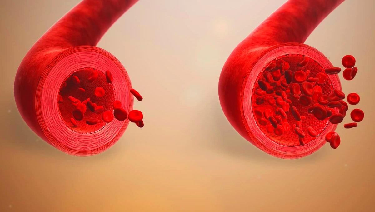 Vasodilation illustrative image. Vasodilation illustrative image.