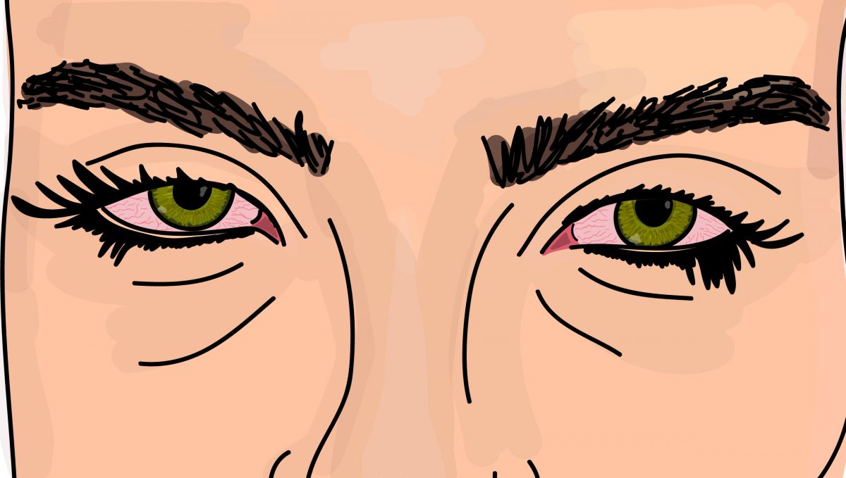 Puffy red eyes are caused by the vasodilation effect of marijuana. Puffy red eyes are caused by the vasodilation effect of marijuana.