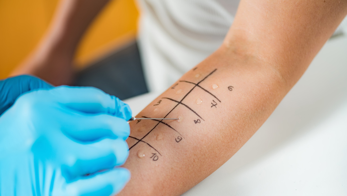 Skin tests are performed to discover cannabis allergy.