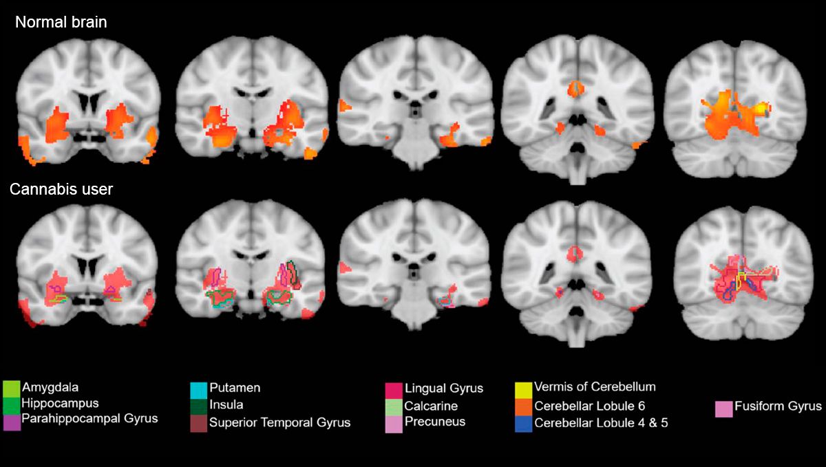 Does Cannabis Cause Memory Loss? – MRI scans comparing the brains of cannabis smokers vs non-smokers